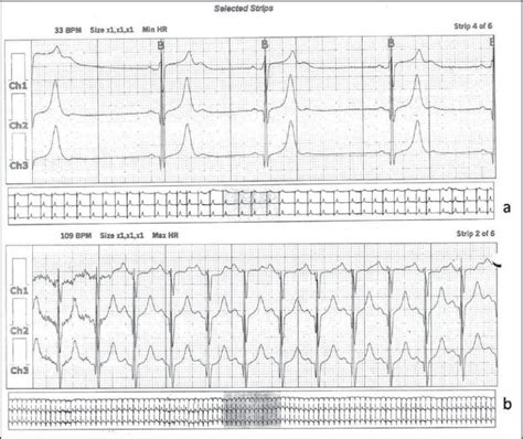 24 Hour Holter Recording Demonstrating The Typical Download Scientific Diagram