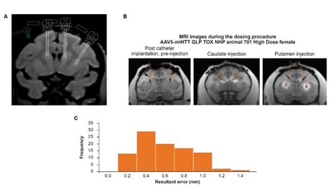 Successful Mri Guided Convection Enhanced Delivery Of Aav Mihtt To