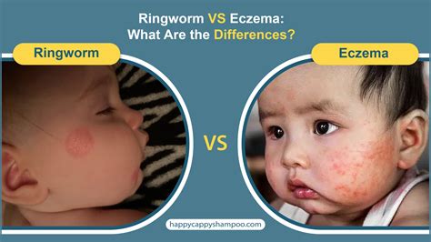 Ringworm Vs Eczema What Are The Differences Happy Cappy