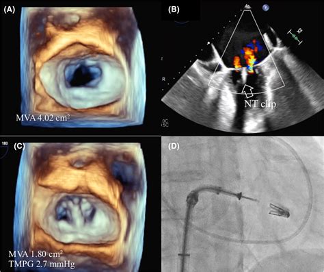 Threedimensional Transesophageal Echocardiographyguided Transseptal