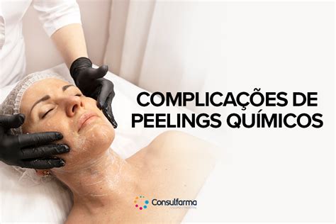 Complica Es De Peelings Qu Micos Consulfarma