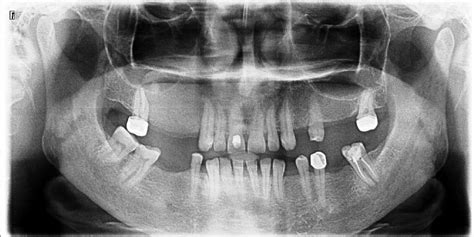 Fibrous Dysplasia Of Maxilla