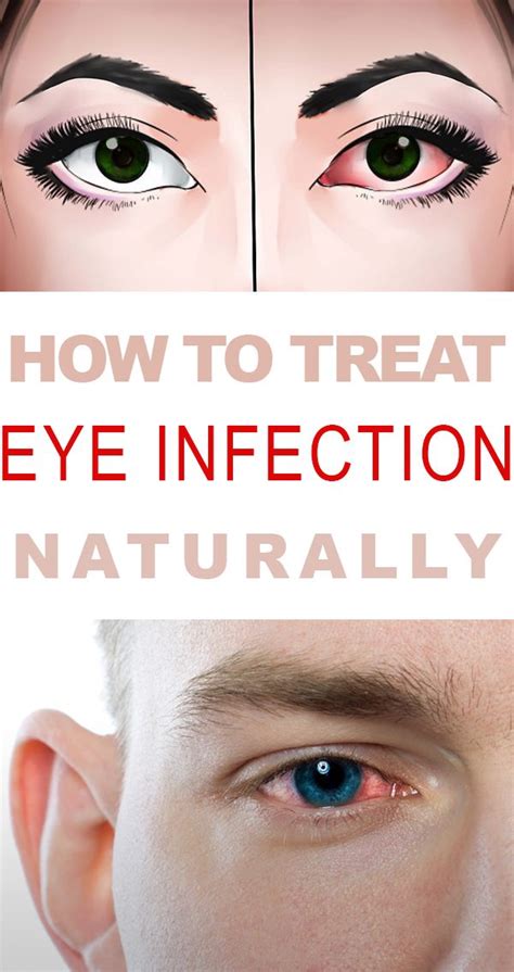 How To Treat Eye Infection Naturally Reduce Inflammation Natural Remedies Natural Remedies