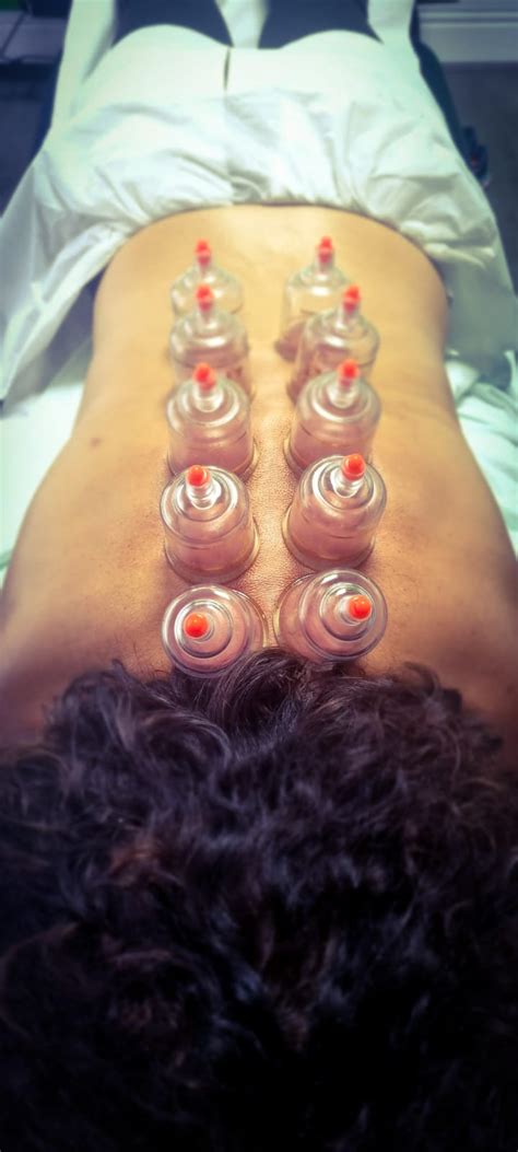 cupping therapy spine fine