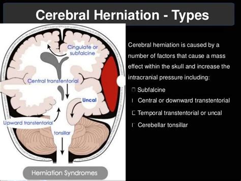 Brain Herniation Syndrome