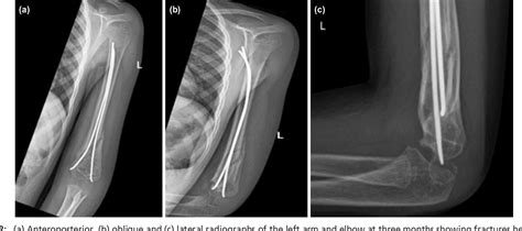 Figure 2 From Distal Humeral Shaft Fracture With Simultaneous