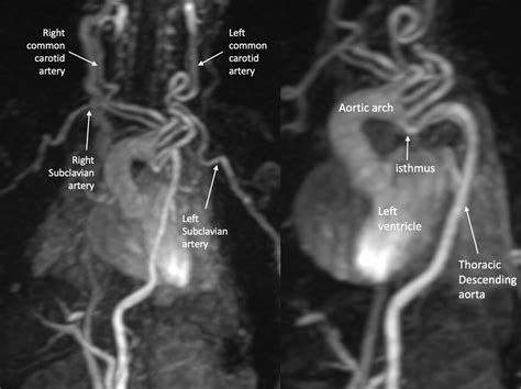 Arterial Tortuosity Syndrome in a Term Neonate - The Annals of Thoracic Surgery