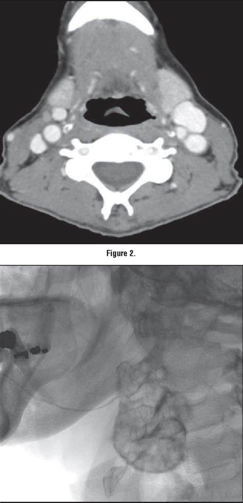 Radiology Quiz Case 1 Iodine 131induced Sialadenitis Semantic Scholar