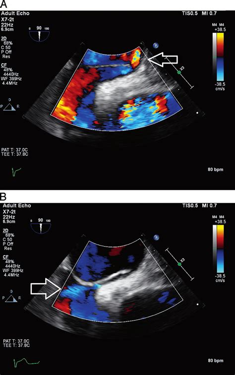 Transesophageal Echocardiography Tee Still Images A Right To Left Download Scientific