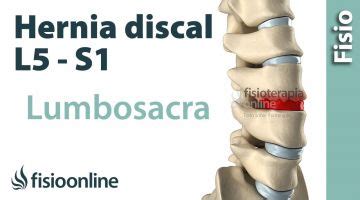 Ejercicios De Pilates Recomendado En Caso De Hernia Discal Lumbar