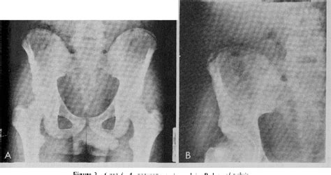 Figure 3 From Iliac Apophysitis And Stress Fractures In Adolescent Semantic Scholar