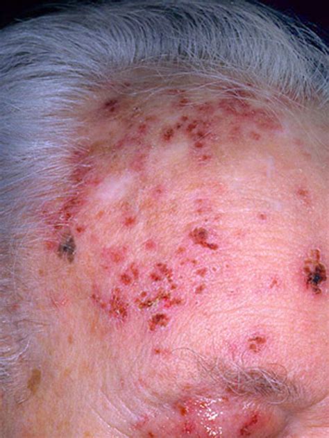 Is It Shingles Myths About Painful Illness Graphic Images