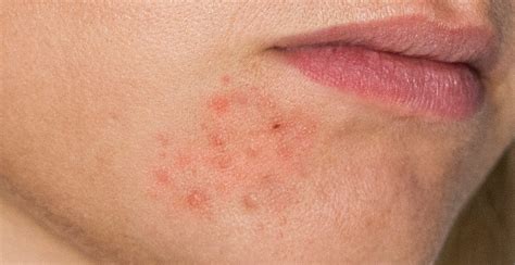 Perioral Dermatitis Causes Symptoms Treatment Off