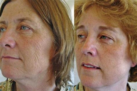 This Is What 7 Smoker Vs Non Smoker Identical Twins Look Like After