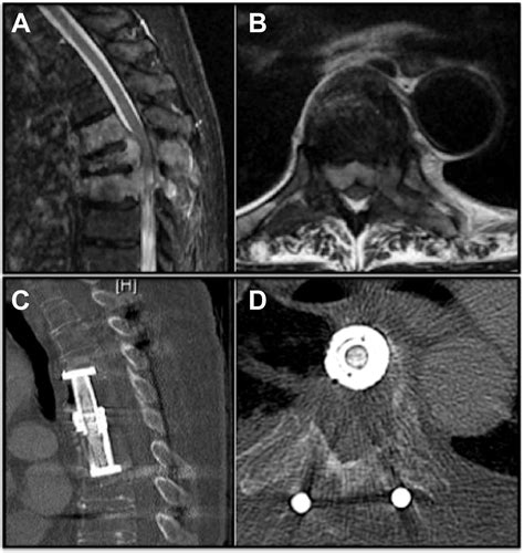 Minimally Invasive Direct Lateral Corpectomy MIDLaC Of The Thoraco