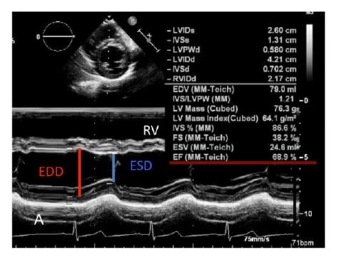 Left Ventricular Measurements