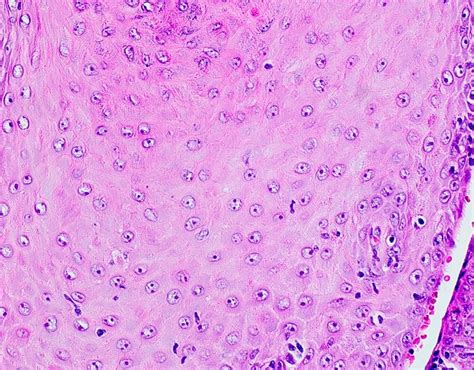 Xeroderma Pigmentosum Histology