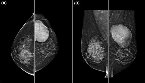 Malignant Transformation Of Phyllodes Tumor A Case Report And Review