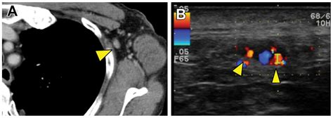 Accurate Diagnosis Of Axillary Lymph Node Metastasis Using Contrast