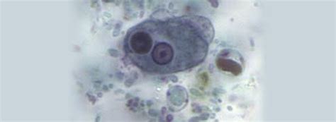 Entamoeba Hystolitica Vs Entamoeba Dispar Edulabc