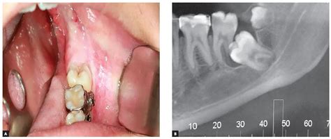 Scielo Brasil Taking Advantage Of An Unerupted Third Molar A Case