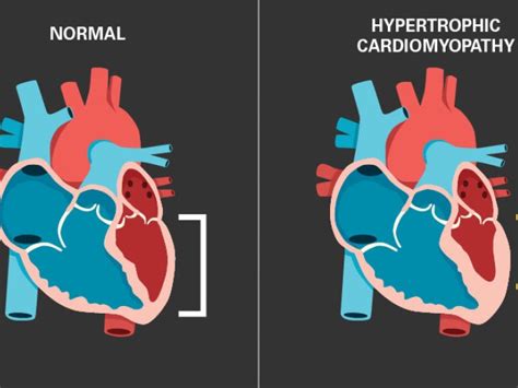 Hypertrophic Cardiomyopathy Michigan Medicine