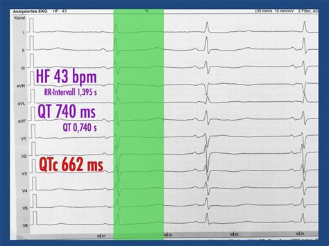 Qt Zeit Im Ekg Nebenwirkungen Von Medikamenten Cardiopraxis