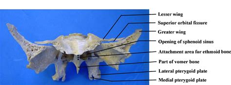 Lateral Pterygoid Plate Of Sphenoid Bone