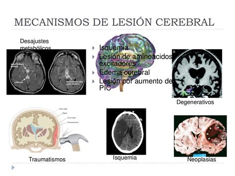 Mecanismos De Lesión Cerebral