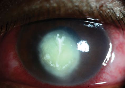 Fungal Corneal Ulcer