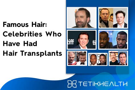 Famous Hair Celebrities Who Have Had Hair Transplants Tetik Health