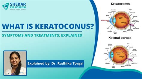 What Is Keratoconus Causes And Treatment Options Explained Youtube