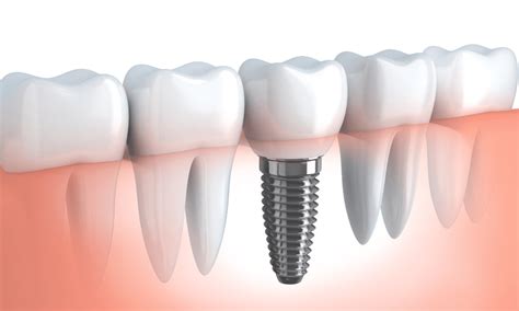 Why Is Dental Implant Maintenance So Important Fayette Dental Group