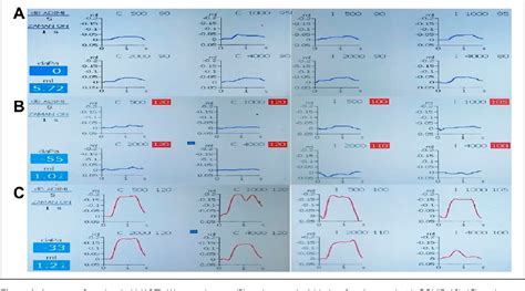 Figure 1 from Evaluation of Acoustic Reflex Thresholds in COVID-19 ...