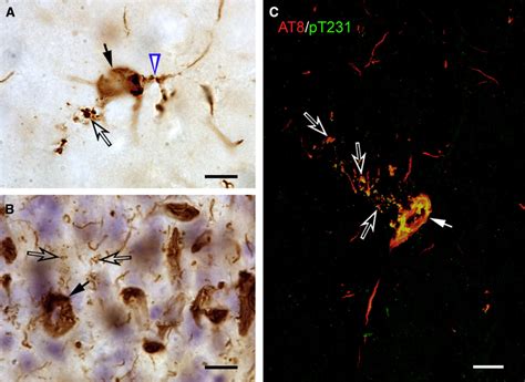 Tau Aggregates Are Released From Degenerated Tangle Bearing Neurons