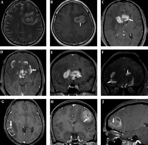 A A Primary Central Nervous System Lymphoma Pcnsl Lesion On Axial Download Scientific