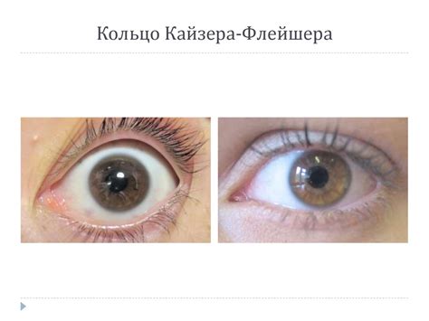 Кольцо Кайзера Флейшера Фото — Фото Картинки