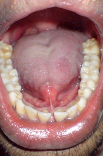 Tongue Tie And Midline Dermoid Cyst Dr K O Paulose Frcs