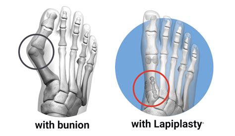 Lapiplasty 101 Everything You Need To Know About Lapiplasty 3D Bunion