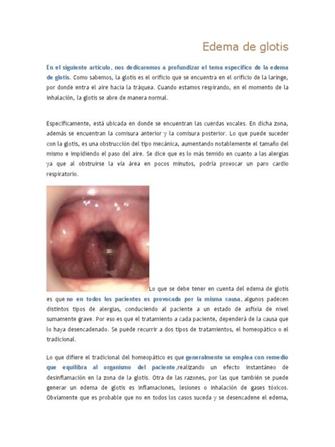 Edema De Glotis Quemar Hueso