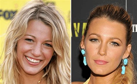 Blake Lively Plastic Surgery inspiration