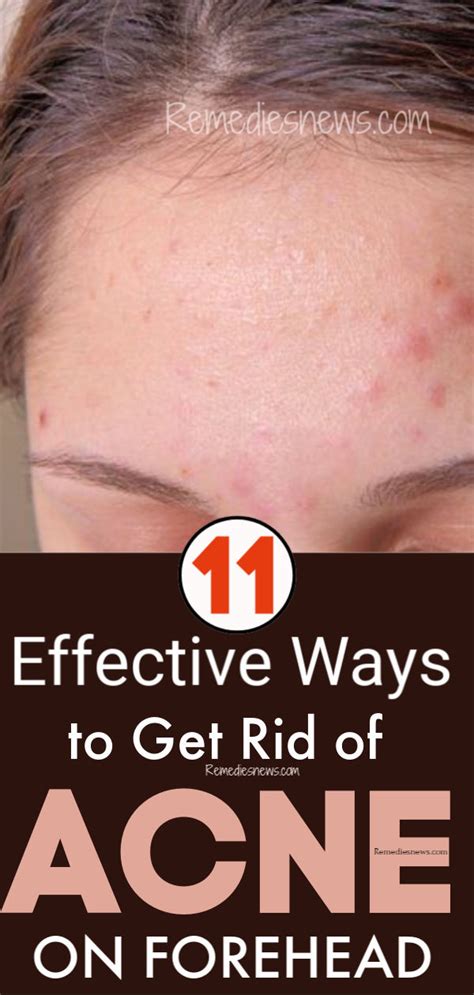 How to Get Rid of Acne on Forehead Overnight-11 Best Acne Remedies