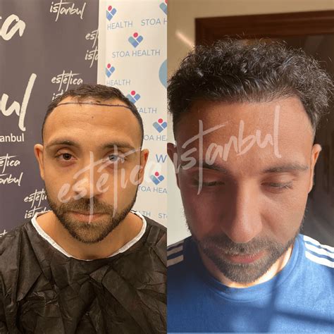 Hair Transplant In Turkey Estetica Istanbul