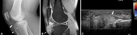 A 52 Year Old Man With Palpable Anterior Knee Mass And Gout Download Scientific Diagram