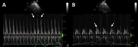 A Transmitral Pulsed Wave Doppler At The Level Of The Mitral Leaflet