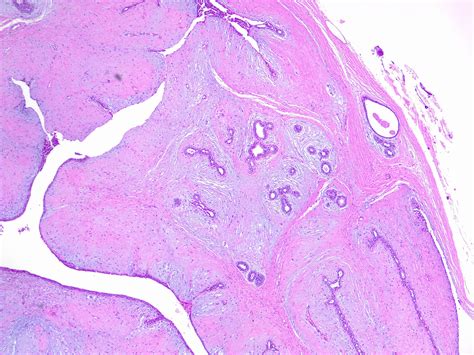 Phyllodes Tumor Of The Breast Article