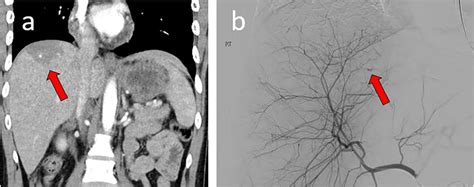 Aast Grade Iii Liver Laceration A In Segment 7 With Possible