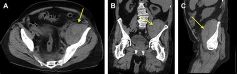 Evaluating The Patient With Left Lower Quadrant Abdominal Pain