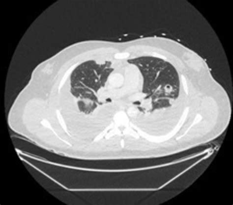 Atypical Presentation Of Lemierre Syndrome In A Young Healthy Man With