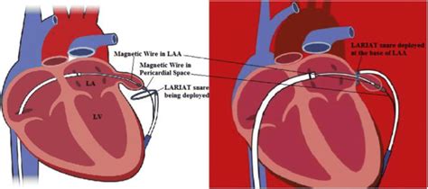 Lariat Device System La Left Atrium Lv Left Ventricle Reproduced